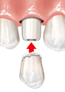 Dental Implant in Gum with Crown (Illustration)