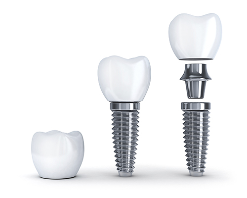 Dental Implant pieces diagram at Timothy H. Kindt, DDS