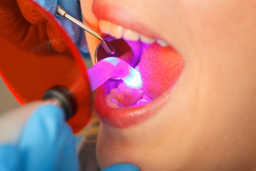 Dental curing lights