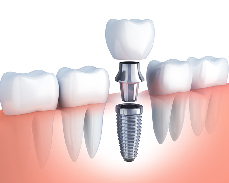 illustration of a single tooth implant from Timothy H. Kindt, DDS in Mesa, AZ