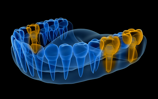 Digital illustration of lower jaw showing multiple teeth replaced with dental implants at Timothy H. Kindt, DDS in Mesa, AZ 