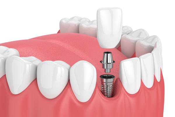 Diagram of a single dental implant at Timothy H. Kindt, DDS in Mesa, AZ