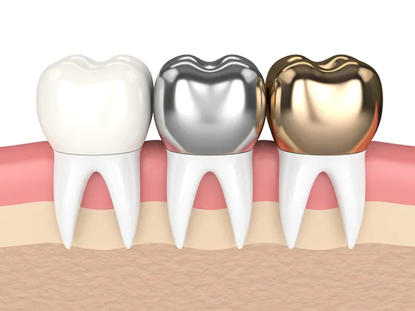 3D rendered cross-section view of three teeth with dental crowns made of different materials at Timothy H. Kindt, DDS in Mesa, AZ