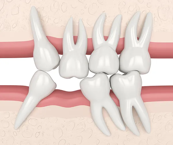 3D rendered view of misaligned teeth crowding the empty space where a missing tooth should be