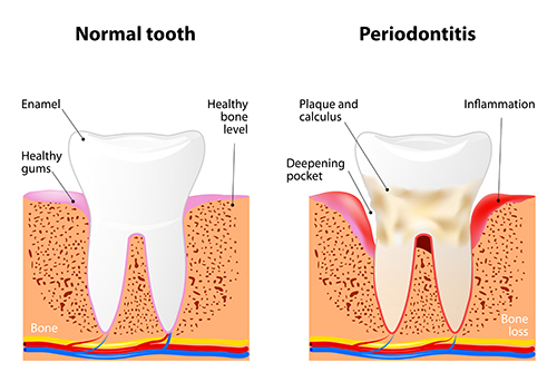 Gum Disease diagram at Timothy H. Kindt, DDS.