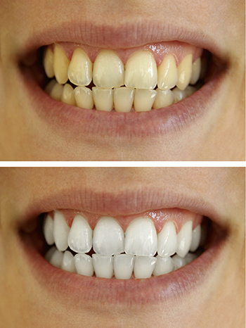 Before and after teeth whitening images at Timothy H. Kindt, DDS in Mesa, AZ