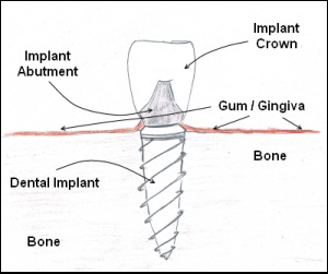 Types of Implants That Can Restore a Lost Tooth