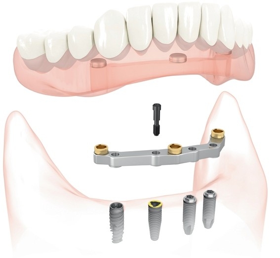 Diagram of implant supported dentures at Timothy H. Kindt, DDS